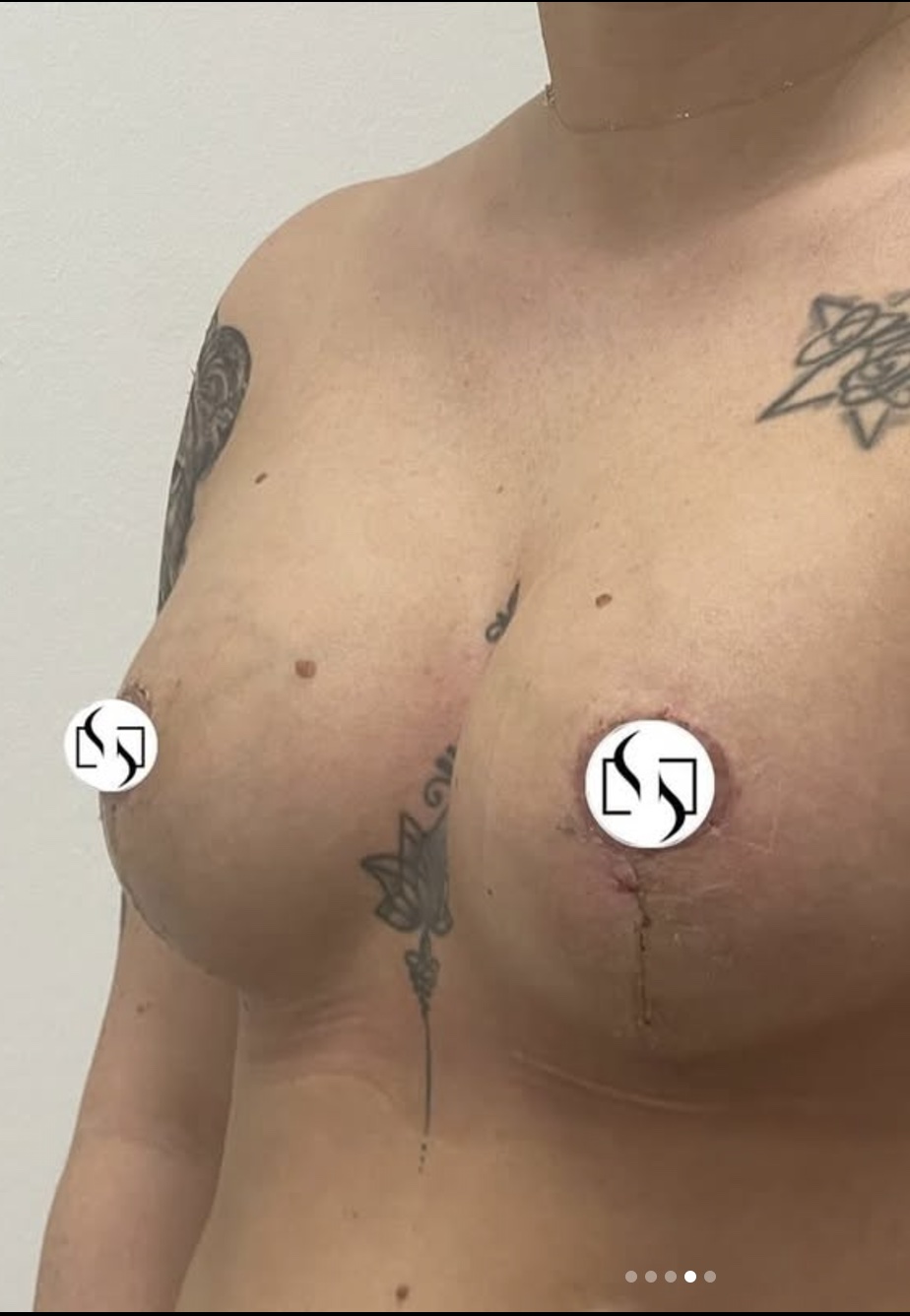 Nachher Foto einer Brustvergrößerung mit Bruststraffung