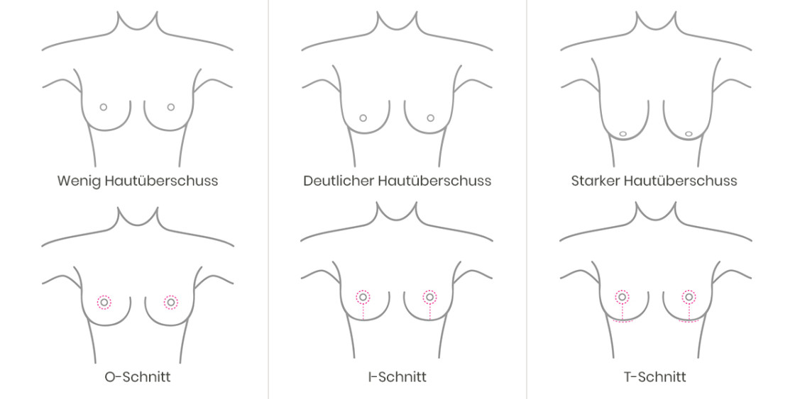Grafik Schnittführung Brustverkleinerung