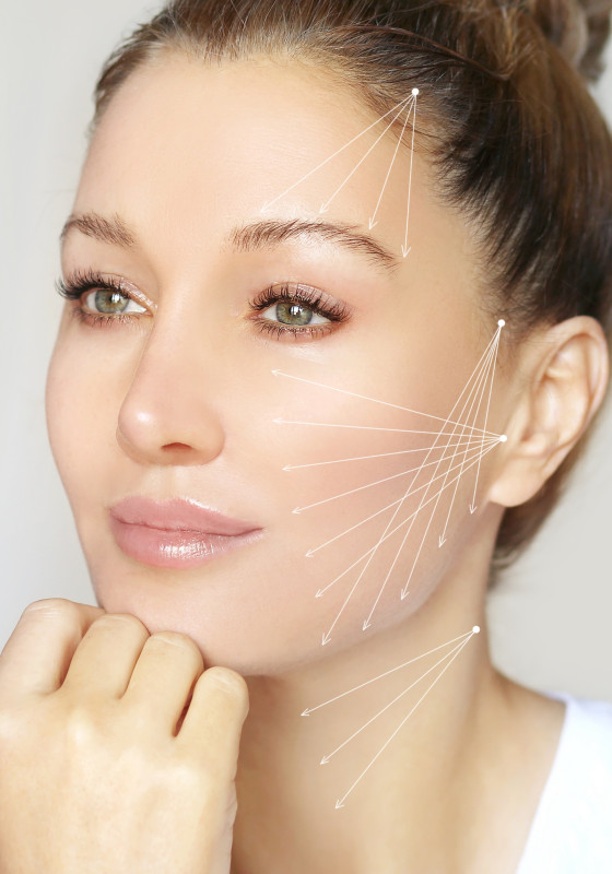 Gesicht einer jungen Frau mit eingezeichneten Linien für ein Fadenlifting