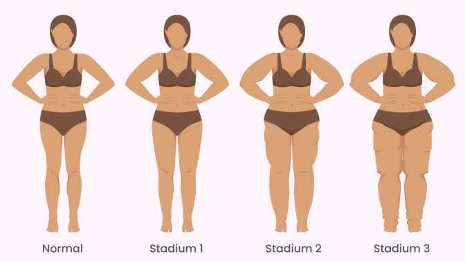 Grafik illustriert die drei Stadien des Lipödems im Vergleich zu einer normalen Person