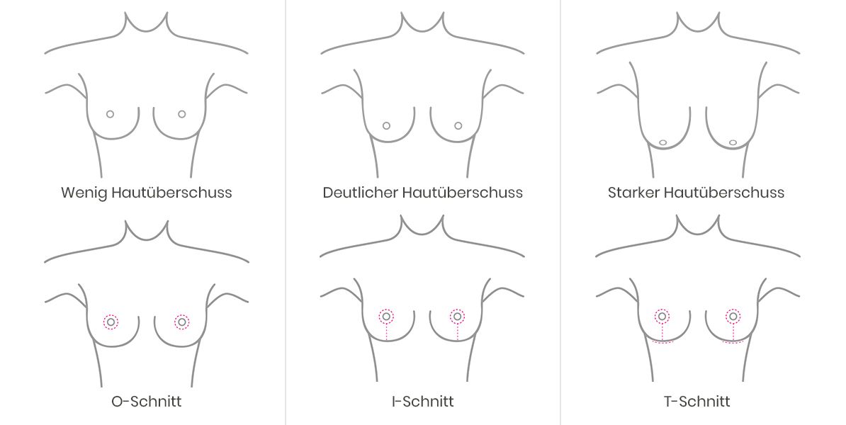 Grafik Schnittführung Brustverkleinerung