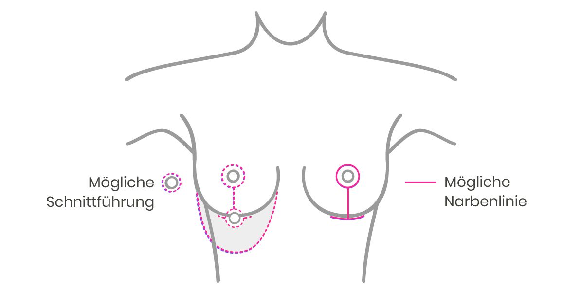 Grafik Schnittführungen Bruststraffung